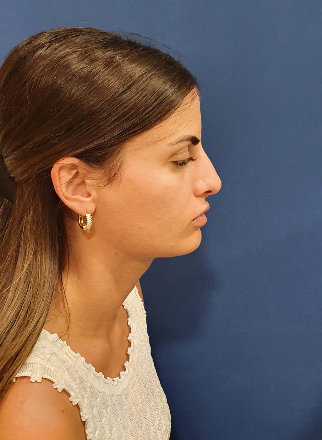 Περιστατικό 15 — φωτογραφία ρινοπλαστικής